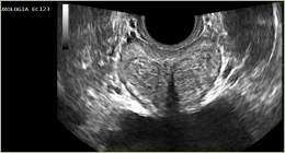 Scansione di ecografia prostatica transrettale