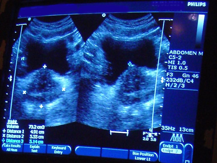 Schermo dell'ecografo con il calcolo del volume prostatico a partire da tre diametri